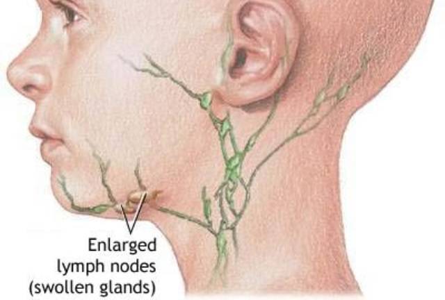 Биопсия лимфоузла на шее - как проводится, кому показана, расшифровка результатов