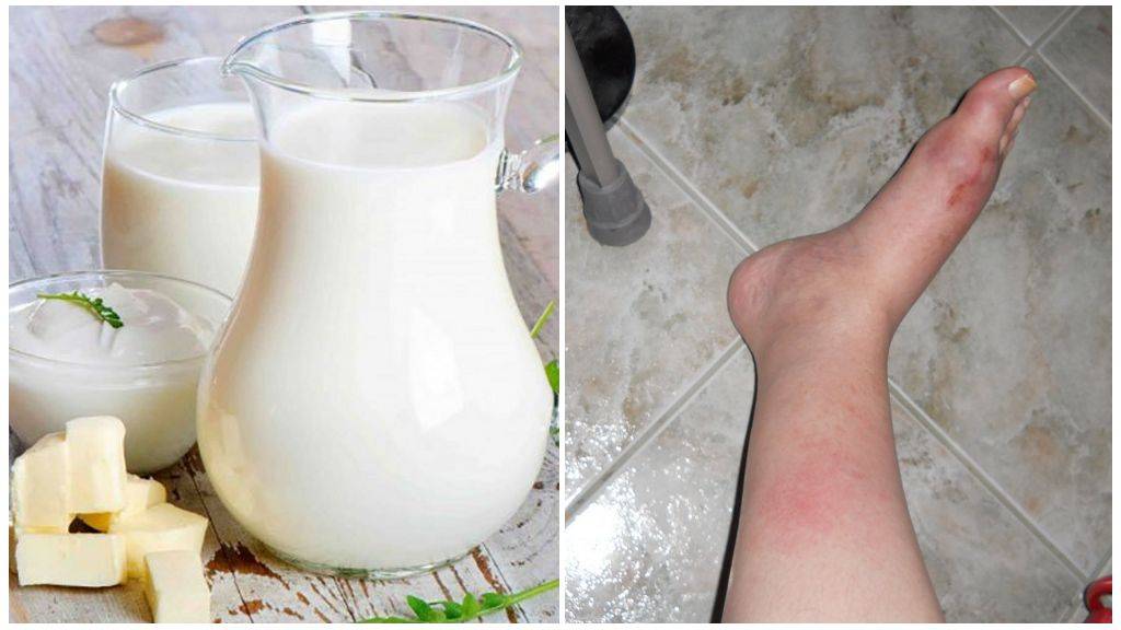 Молоко при гастрите: польза или вред?