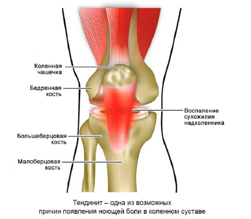 Фото тендинита коленного сустава