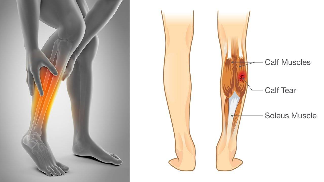 Сводит ноги при ходьбе: чем вызван симптом?