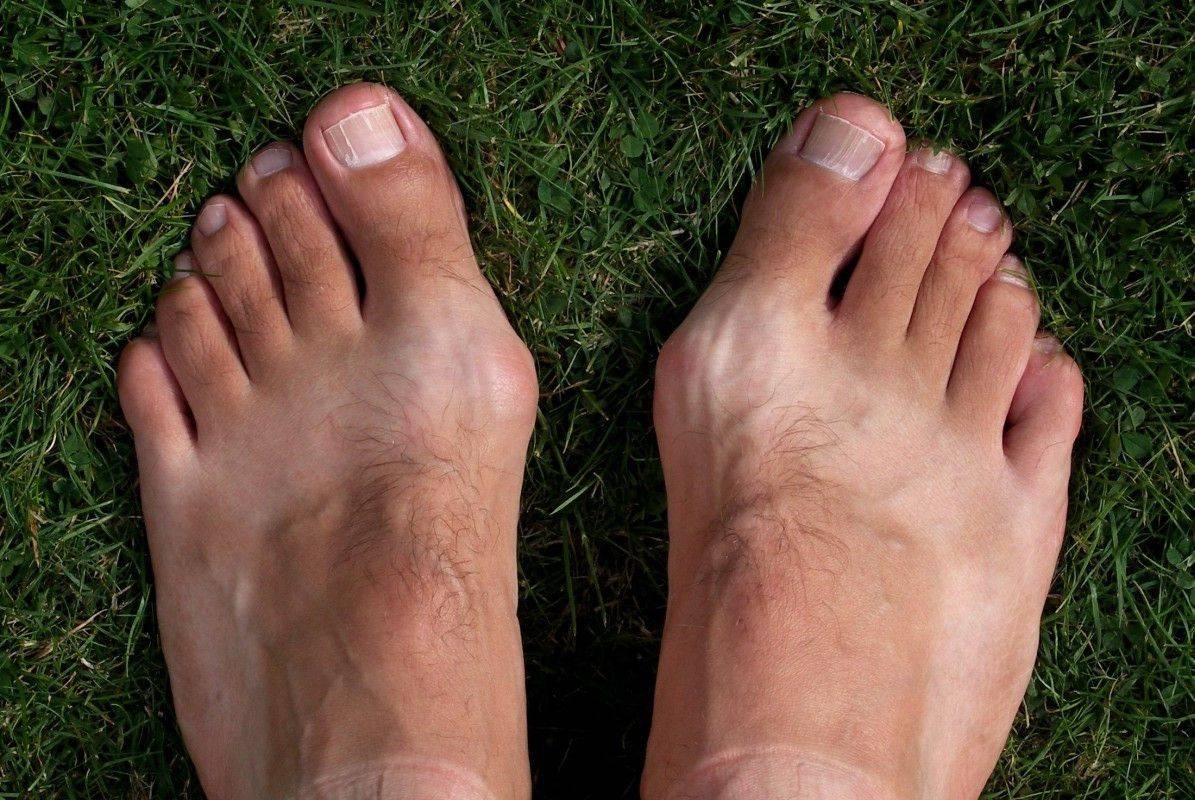 Чем вылечить косточку на большом пальце ноги: способы лечения косточки на ноге