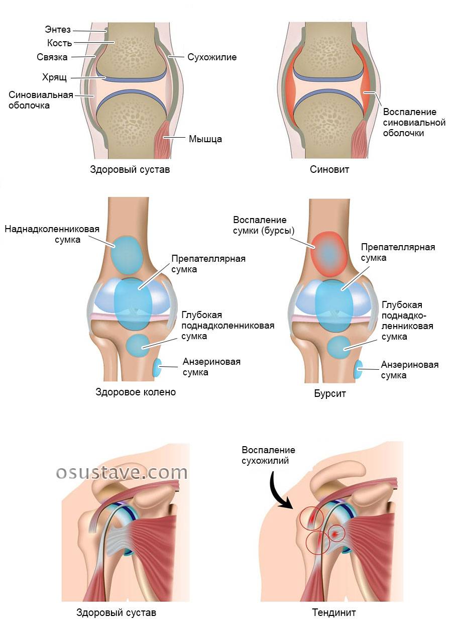 Почему хрустят коленные суставы после эндопротезирования?