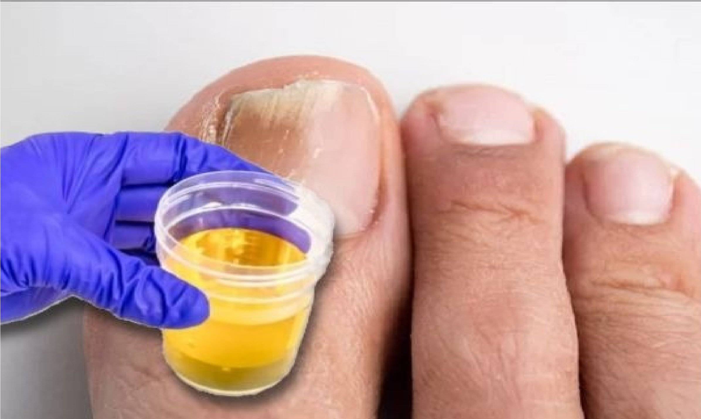 Лечение грибка ногтей народными средствами: самые эффективные