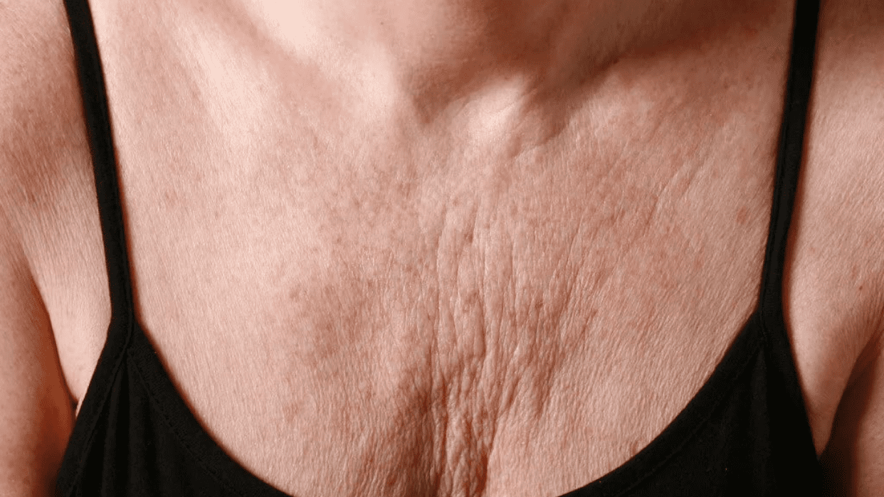кожа на груди не упругая фото 37