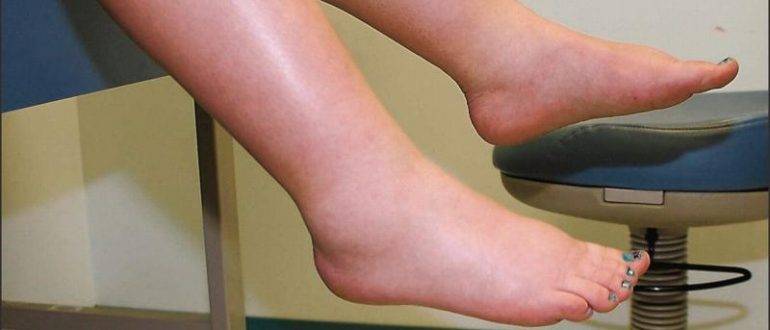 Отеки ног: причины и как убрать отеки на ногах? | anacosma