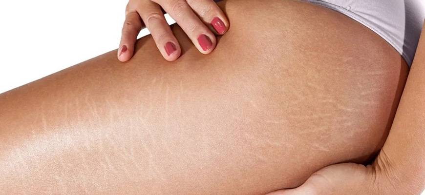 Растяжки на коже (стрии) – причины,  виды, устранение и лечение на теле