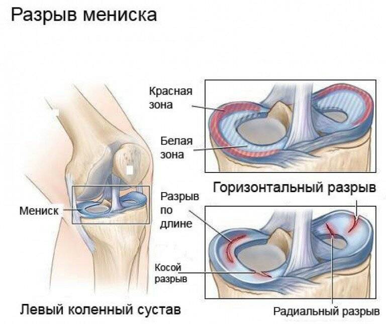 Мениск коленного сустава, операция на мениске, повреждение и лечение мениска