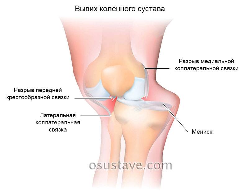 Болит колено, боль в колене правой или левой ноги