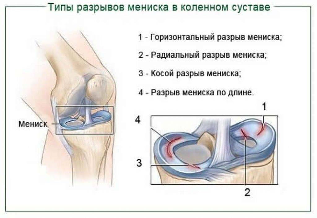 Разрыв мениска коленного сустава: симптомы, признаки, лечение, операция | повреждения менисков колена