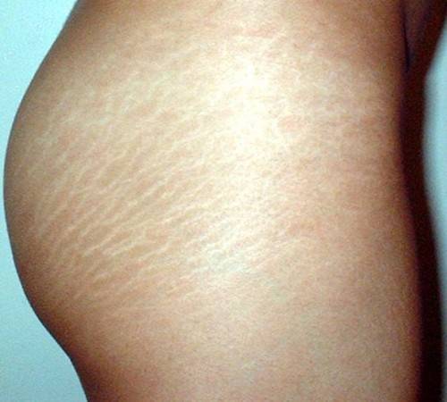 Почему появляются растяжки на коже, лечение растяжек и стрий