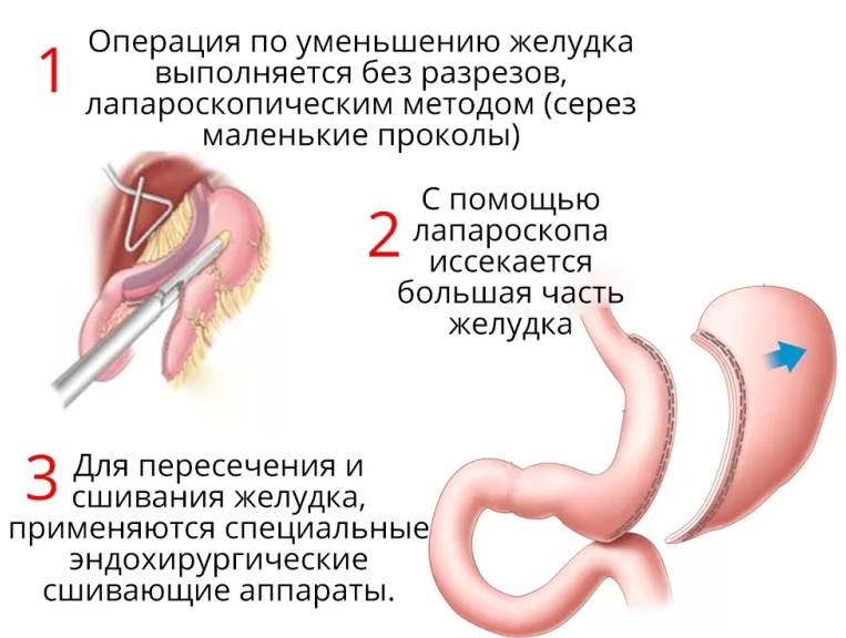 Как снять желудке. Операция по уменьшению желудка. Операция по частичному удалению желудка. Бариатрическая операция резекция желудка. Операция резекция желудка для похудения.