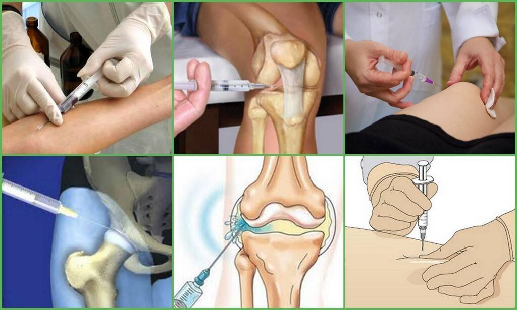 Уколы уколам рознь: какие инъекции делают в суставы при артрозе - нолтрекс.