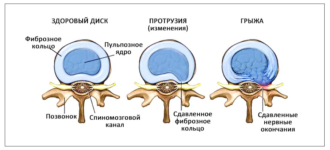 Фиброзное кольцо межпозвоночного диска