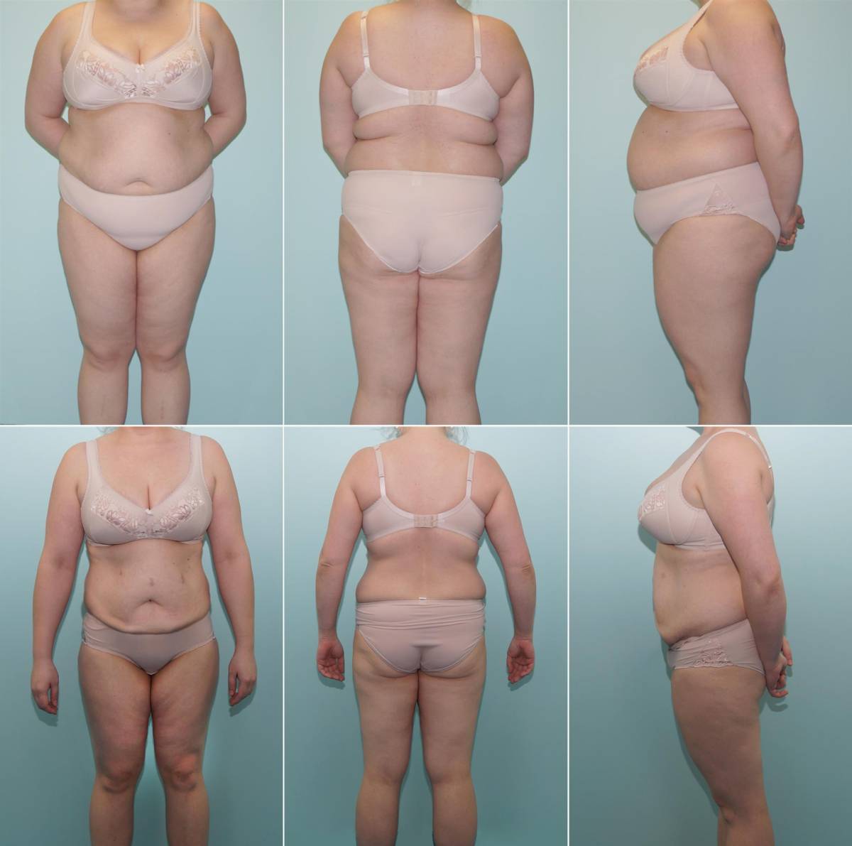 Урезать желудок — не выход: истории людей, набравших вес после бариатрической операции