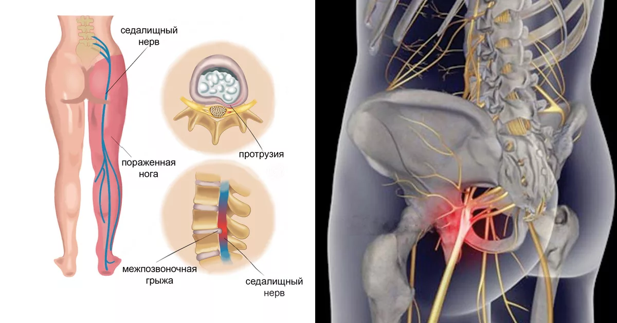 Мышца седалищного нерва. Люмбоишиалгия поясничного отдела позвоночника. Седалищный нерв. Ишиас - защемление седалищного нерва. Защемление седалищного нерва s1.
