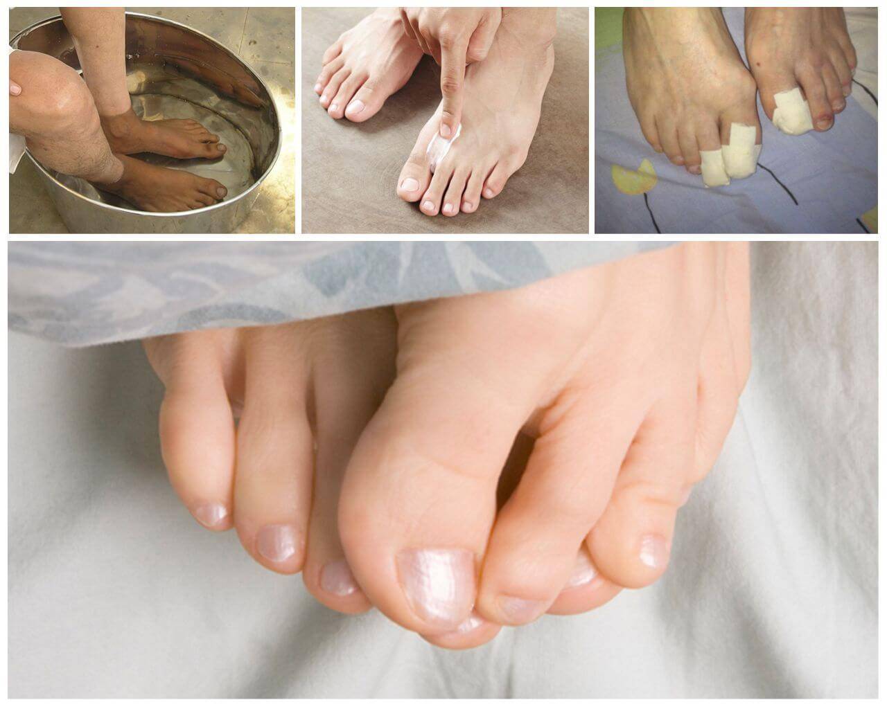 Грибок на ногах: лечение грибка, мази и средства от грибка