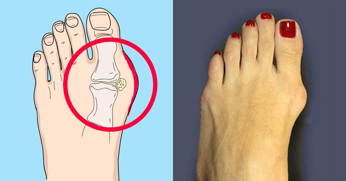 Вальгусная деформация пальца стопы: причины, симптомы и лечение