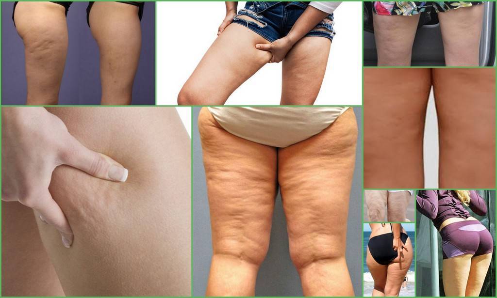О чем расскажут жировые отложения на разных частях тела? и как с ними бороться? :: polismed.com