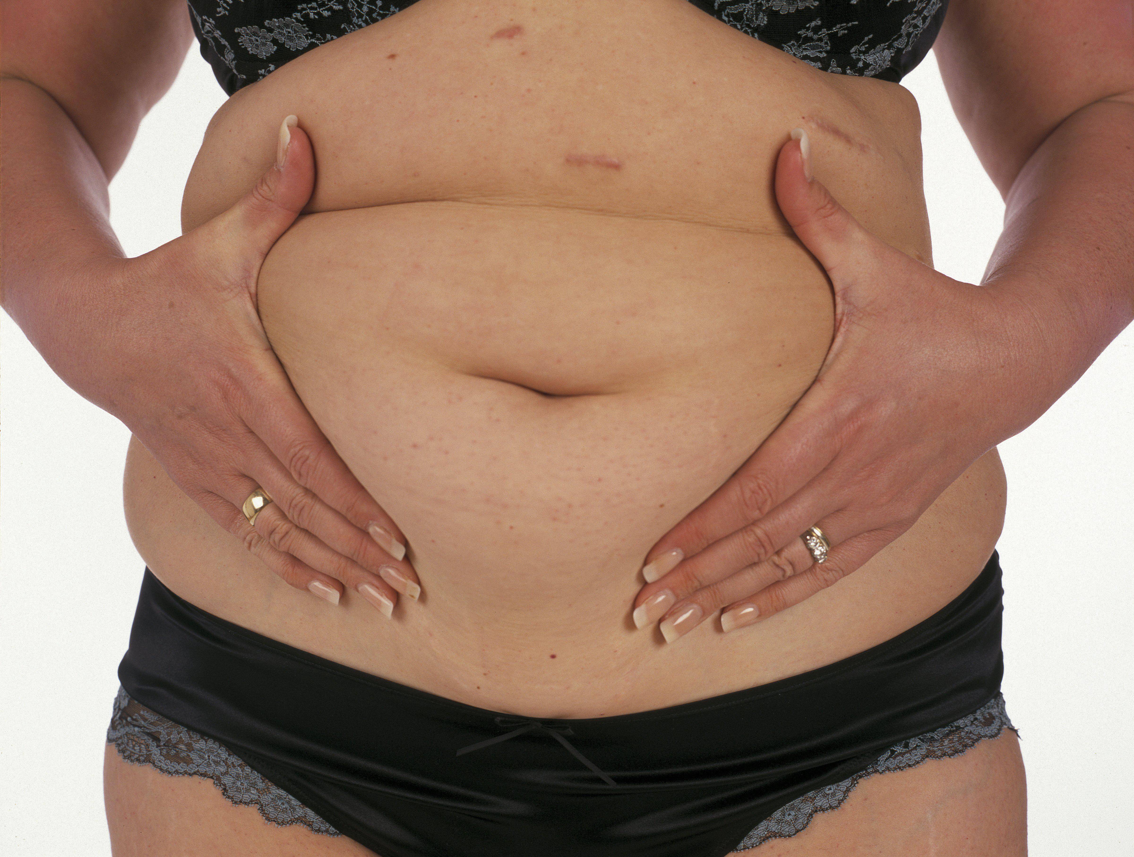 Как убрать жир на животе: главное, определить какой тип жира и дело пойдёт | совет