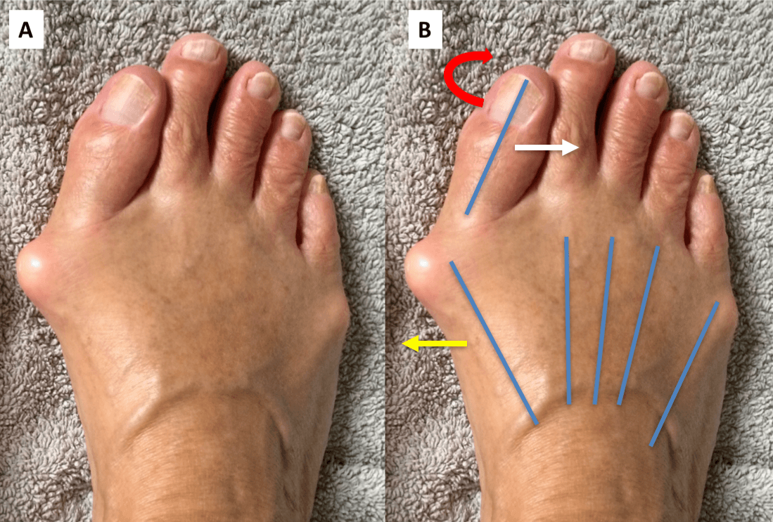Лечение шишек на ногах. почему появляется косточка на большом пальце ноги, и как ее удалить?