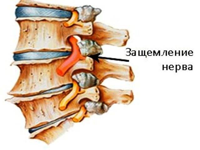 Туннельный синдром - сдавление нерва в костно-мышечном канале.