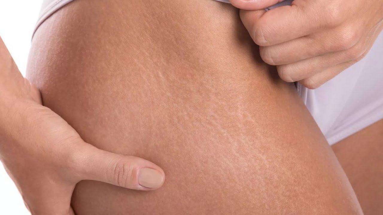 Почему появляются растяжки на коже, лечение растяжек и стрий