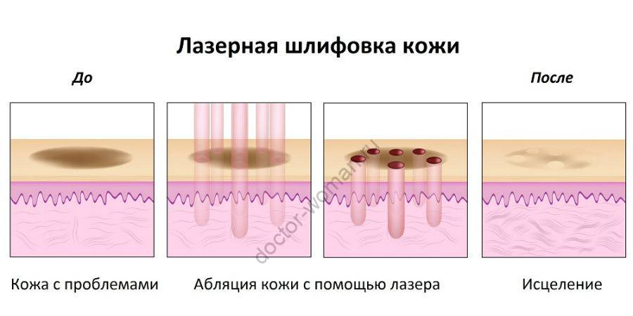 Как рисовать шрамы на лице